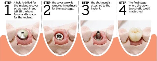 Dental Implants