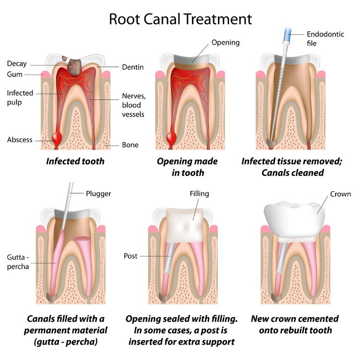 Non-Surgical Root Canal
