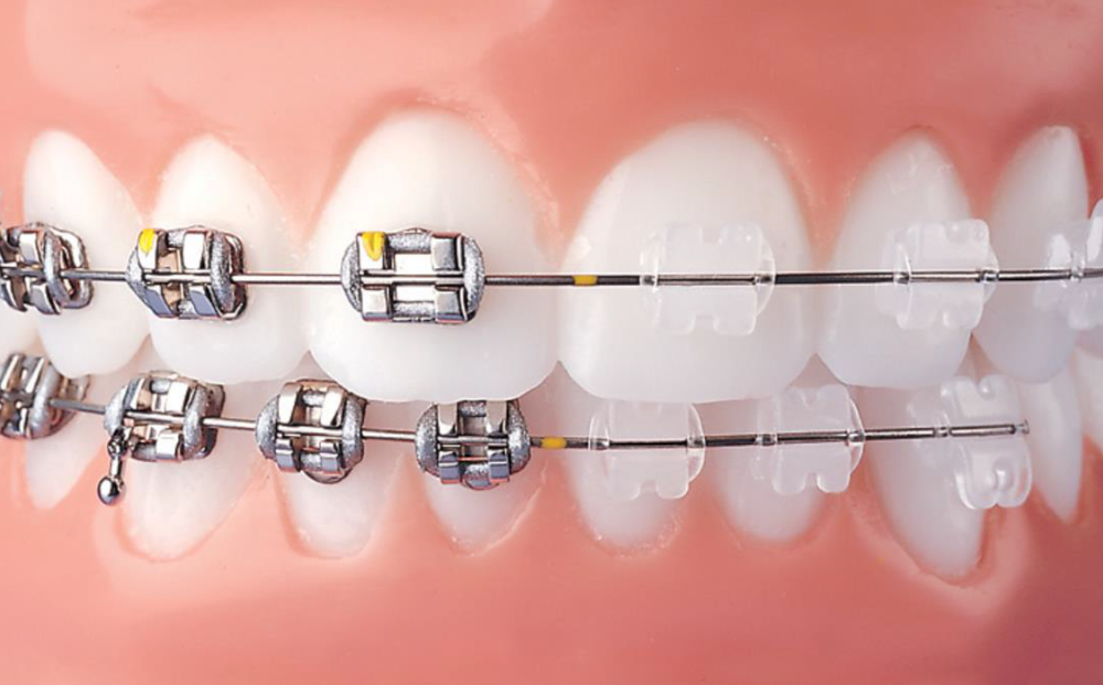 What are Dental Braces?