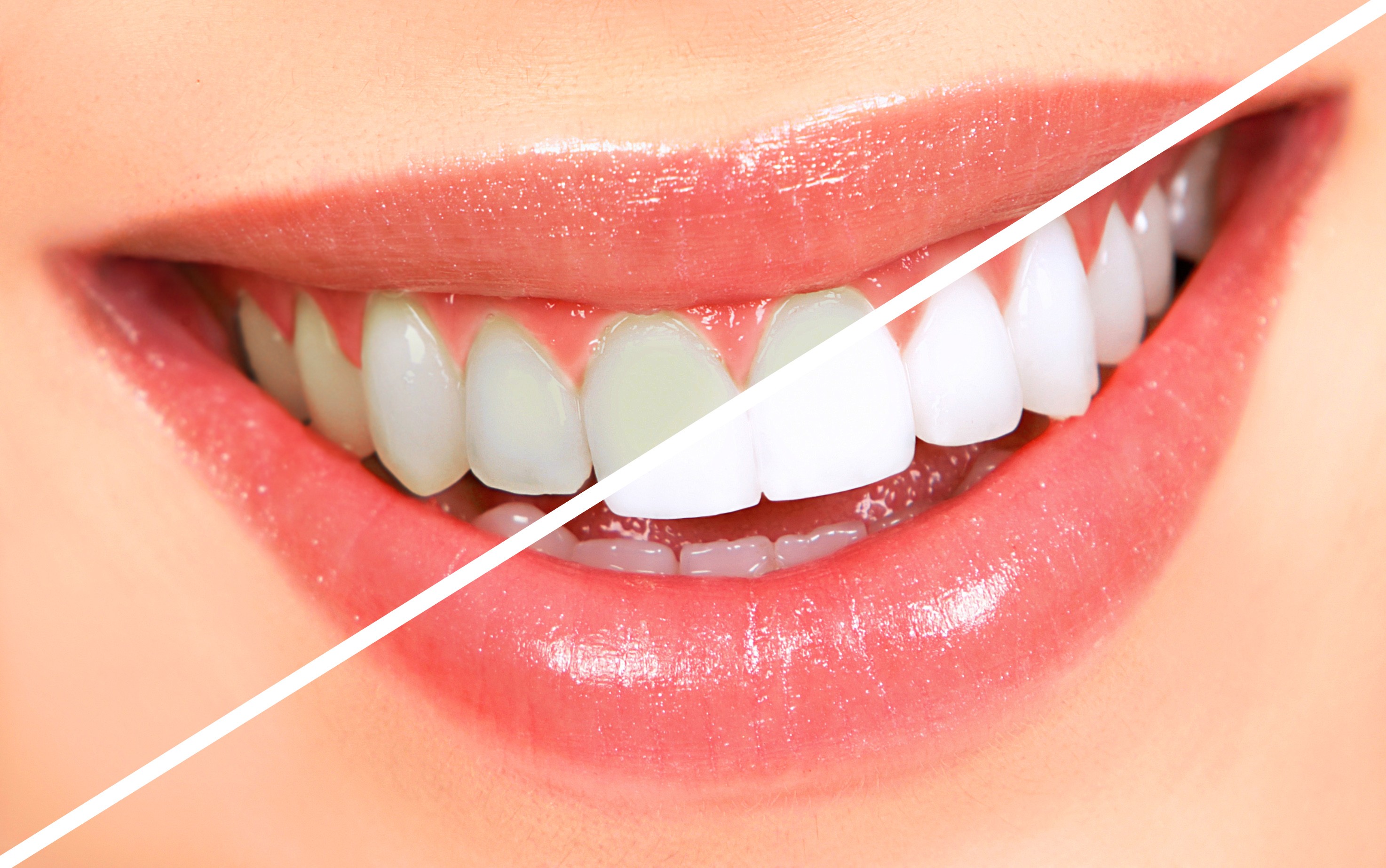 best teeth whitening service dubai